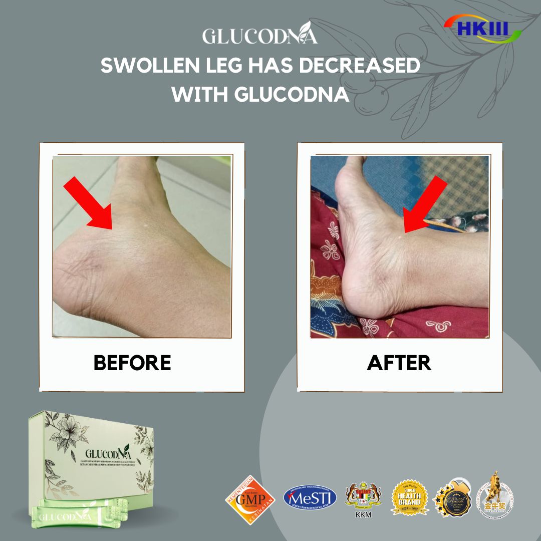 GlucoDNA review stage 4 ckd swollen leg improve